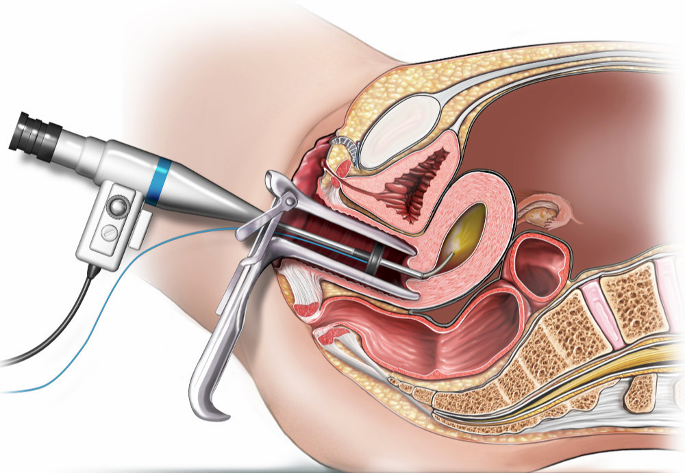 Hysteroscopic Gentle Insertion and Direct Uterine Cavity Visualization