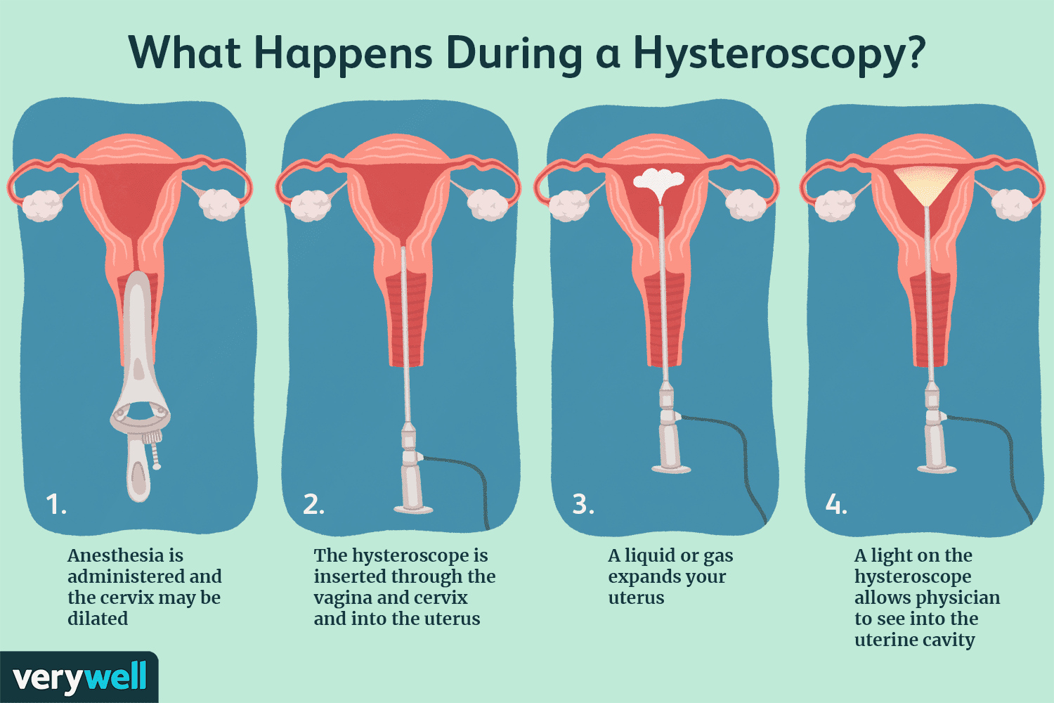 What Happens During a Hysteroscopy Clinical Infographic